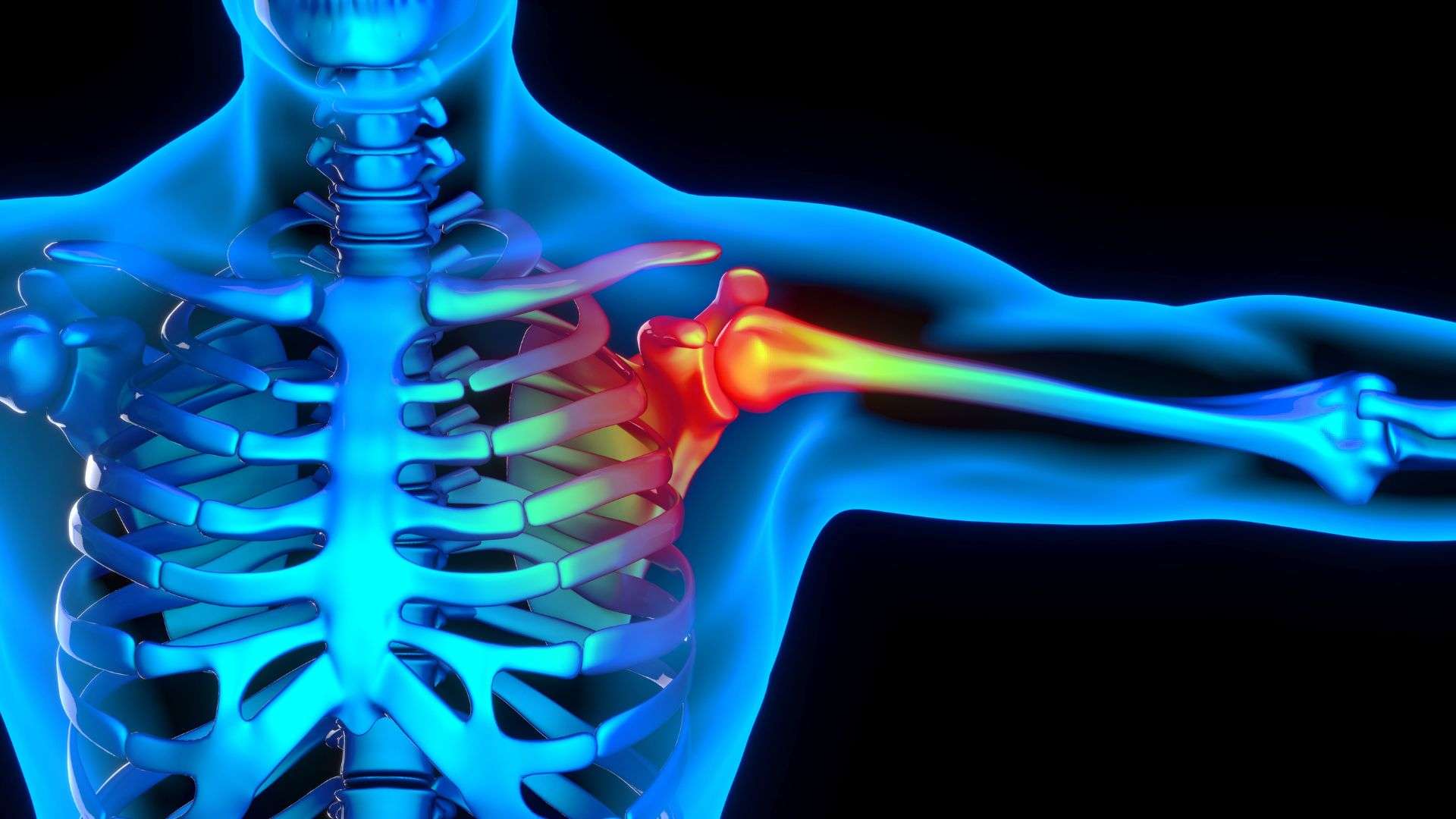 Röntgenbild eines Skeletts mit rot markierten Bereichen in der Schulter